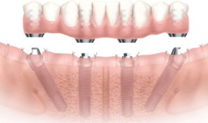 Имплантация зубов All-on-4