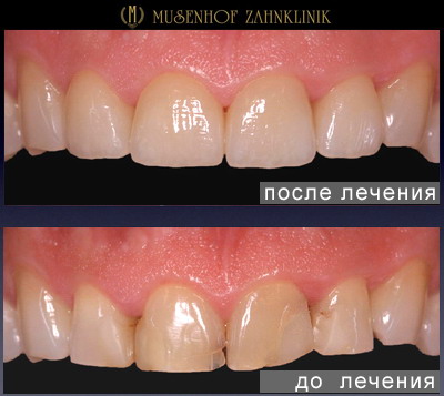 Протезирование зубов в клинике Музенхоф - Дайдесхайм