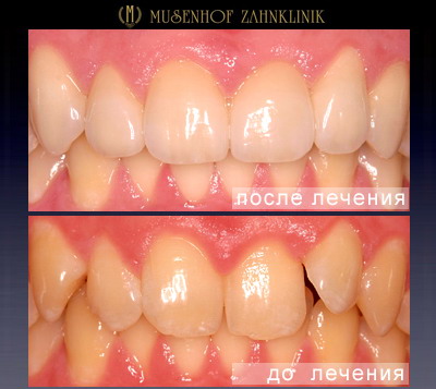 Протезирование зубов в клинике Музенхоф - Дайдесхайм